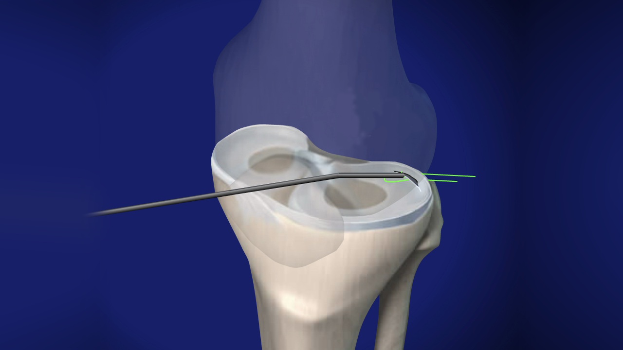 Meniscus Surgery in Croatia related image