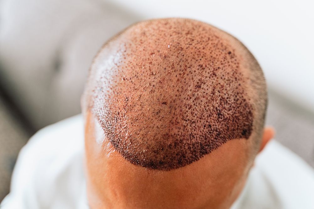 DHI Hair Transplant in Turkey related image
