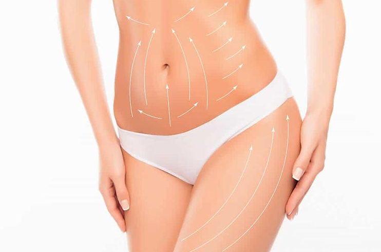 Vaser Liposuction in Turkey related image