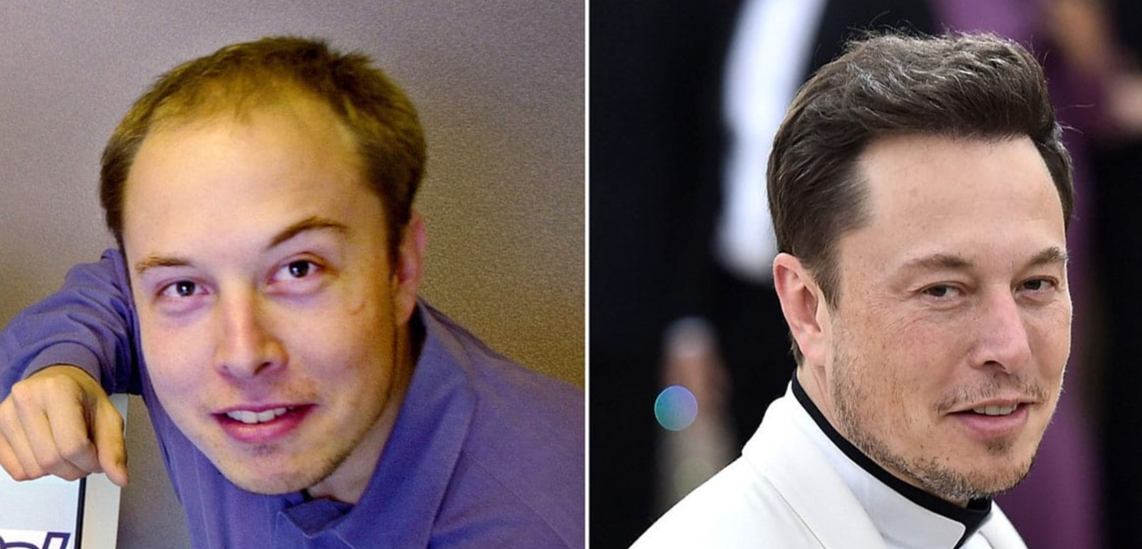 Celebrity Hair Transplants: Confirmed Cases, Costs, Photos related image