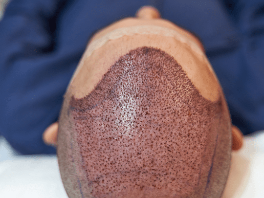 DHI Hair Transplant in Turkey related image