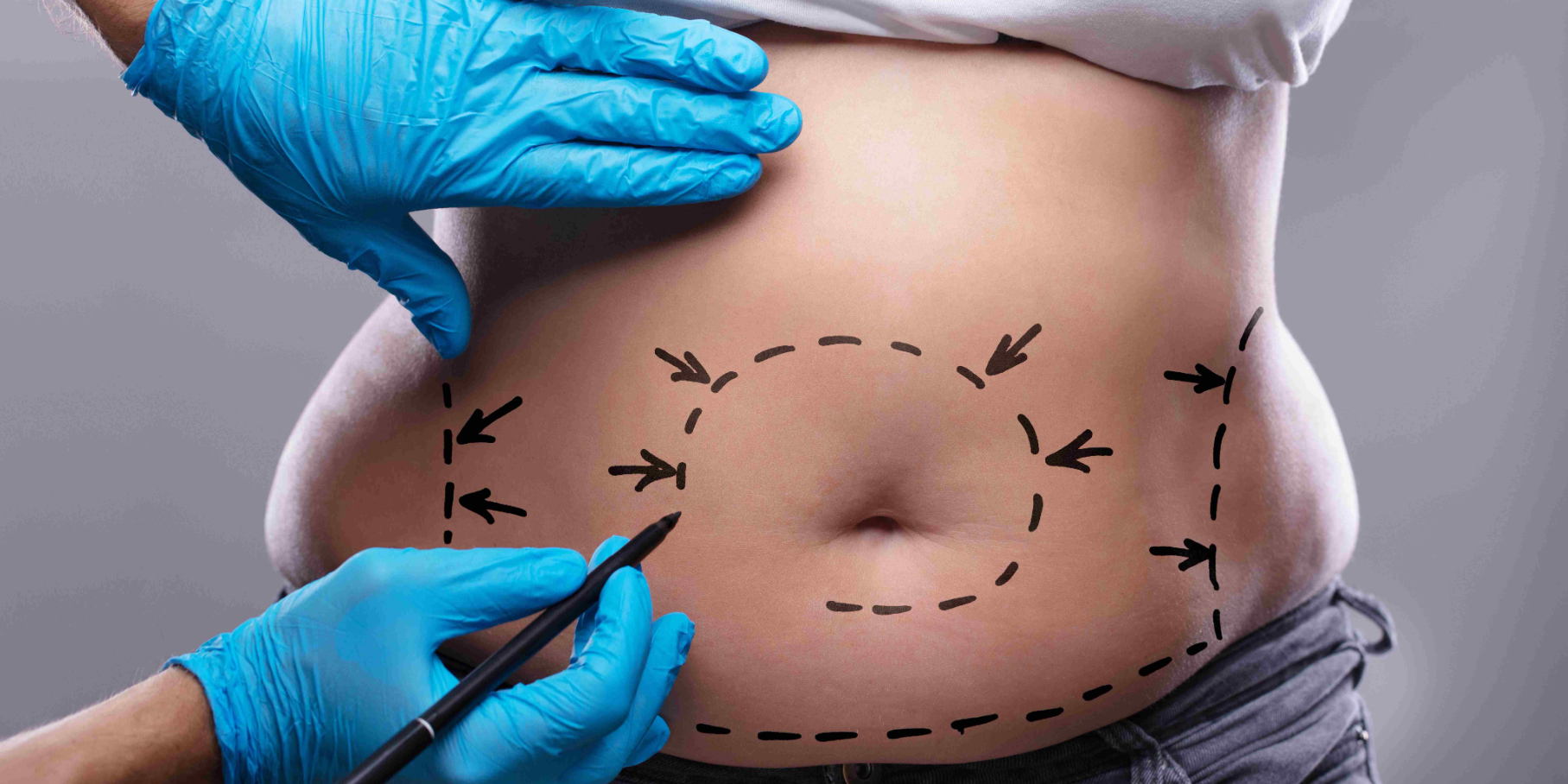 Mini Tummy Tuck in Turkey related image