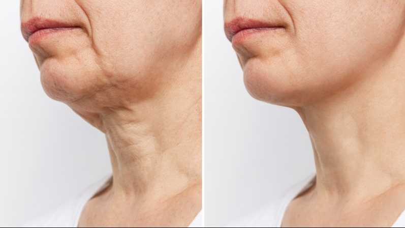 Neck Lift in Turkey related image