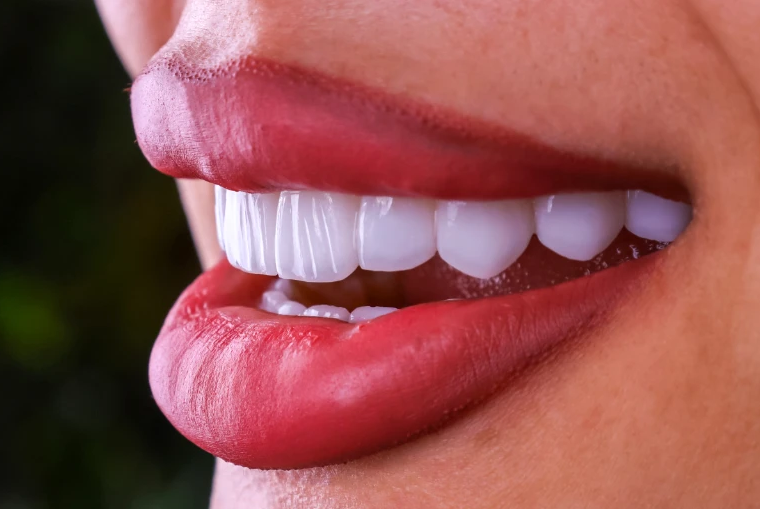Hollywood Smile in Turkey related image