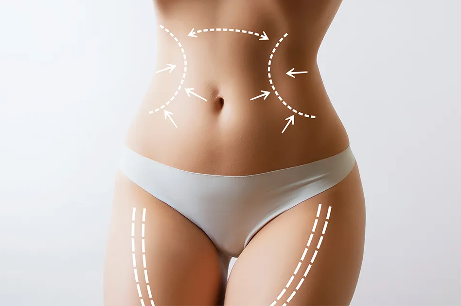 Vaser Liposuction in Turkey related image