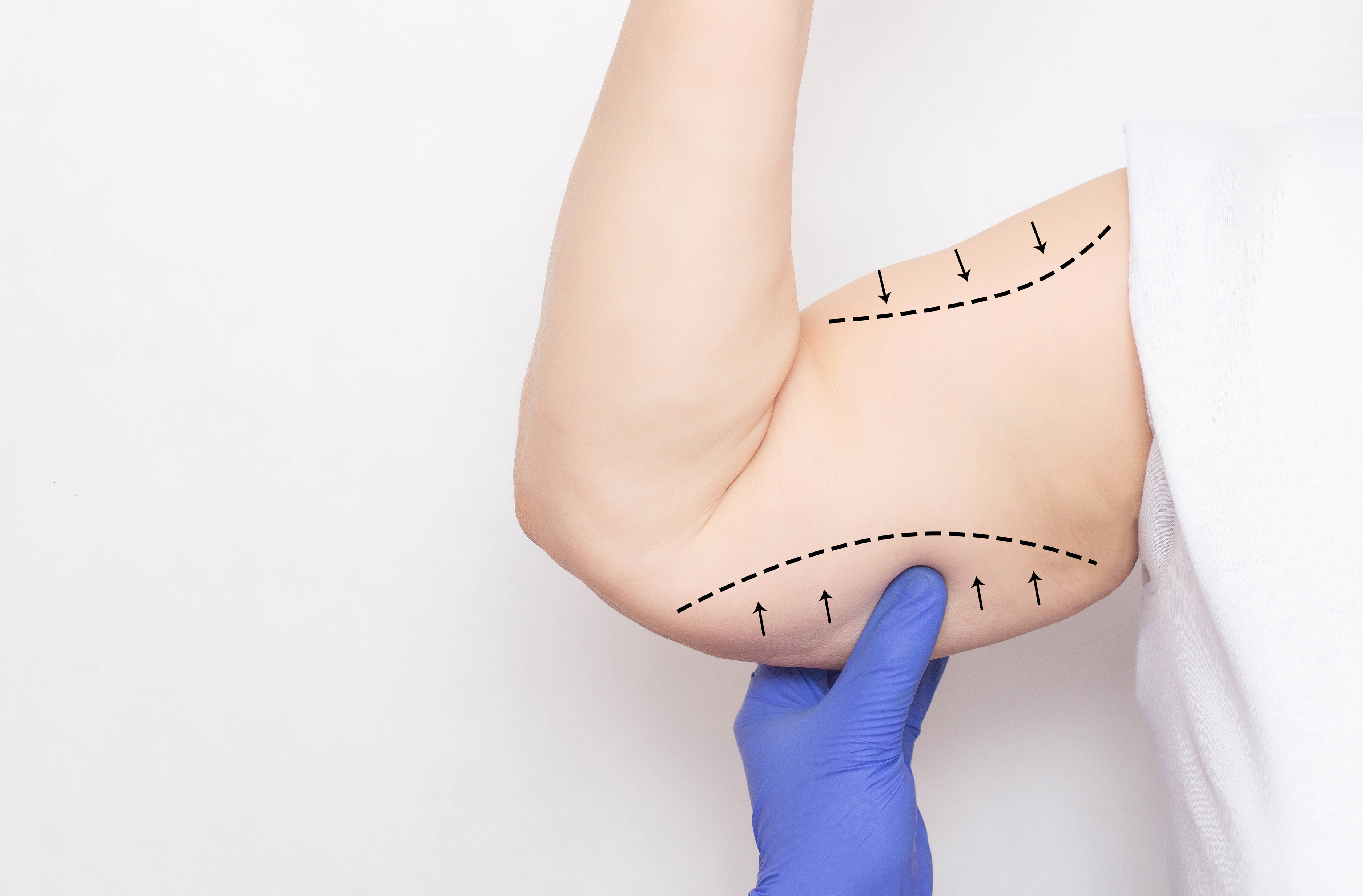 Arm Lift (Brachioplasty) in Turkey related image
