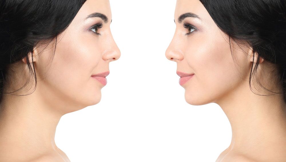 Chin Liposuction (Double Chin) in Turkey related image