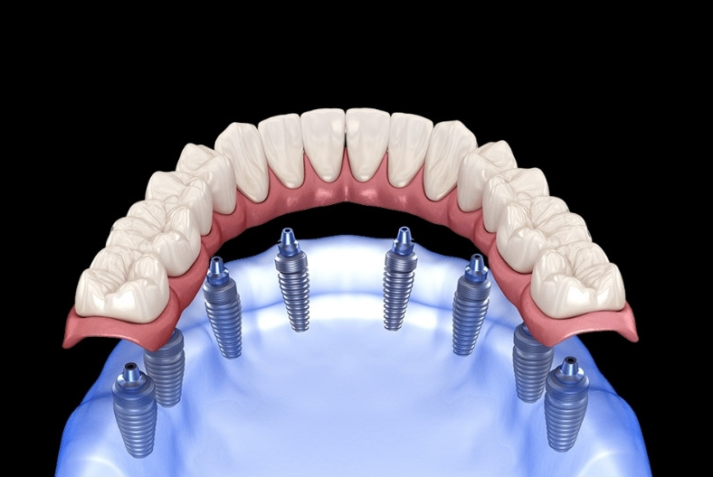All-on-8 Dental Implants in Turkey related image