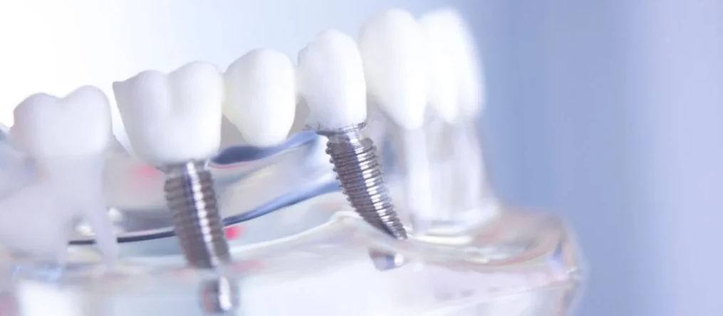 All-on-8 Dental Implants in Turkey related image