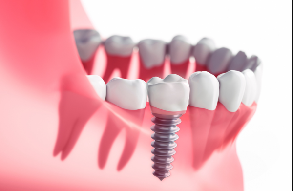 All-on-8 Dental Implants in Turkey related image