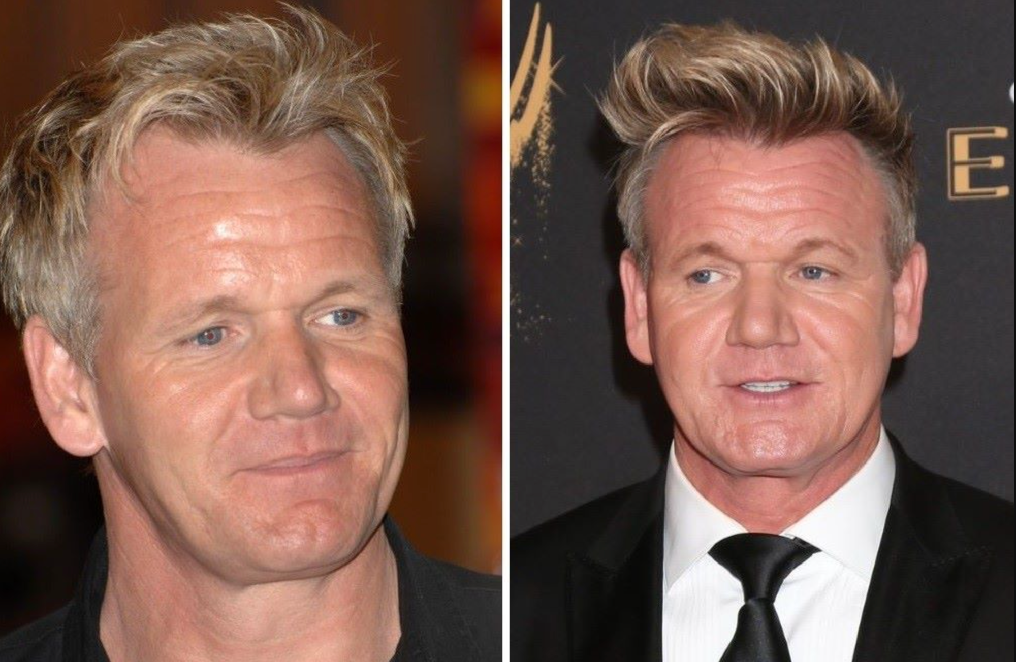 Celebrity Hair Transplants: Confirmed Cases, Costs, Photos related image