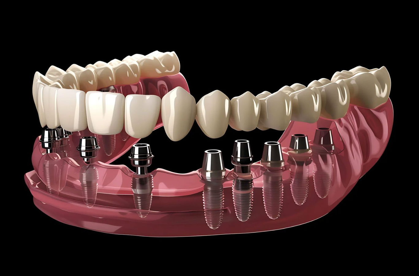 All-on-8 Dental Implants in Turkey related image
