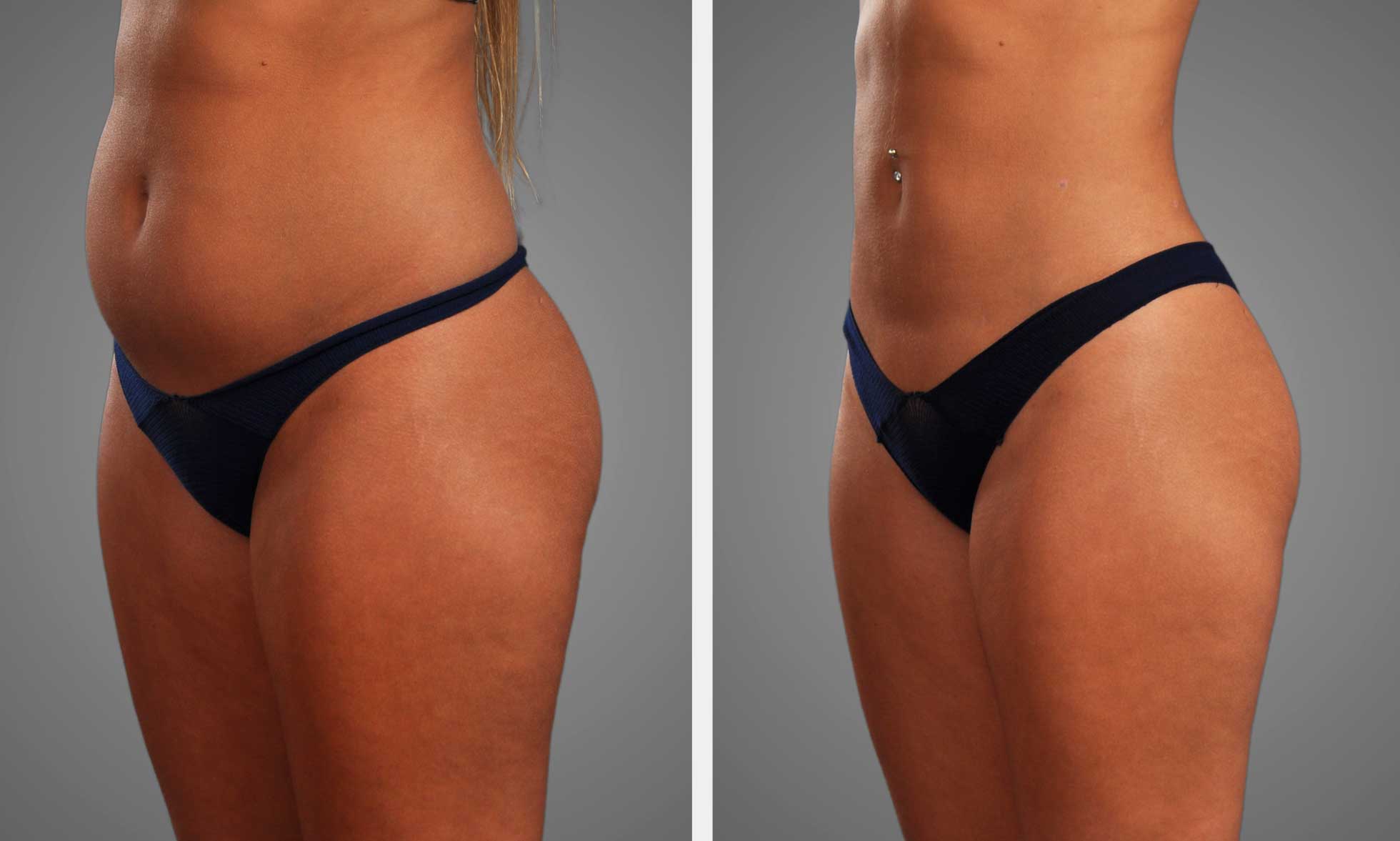 360 Liposuction in Turkey related image