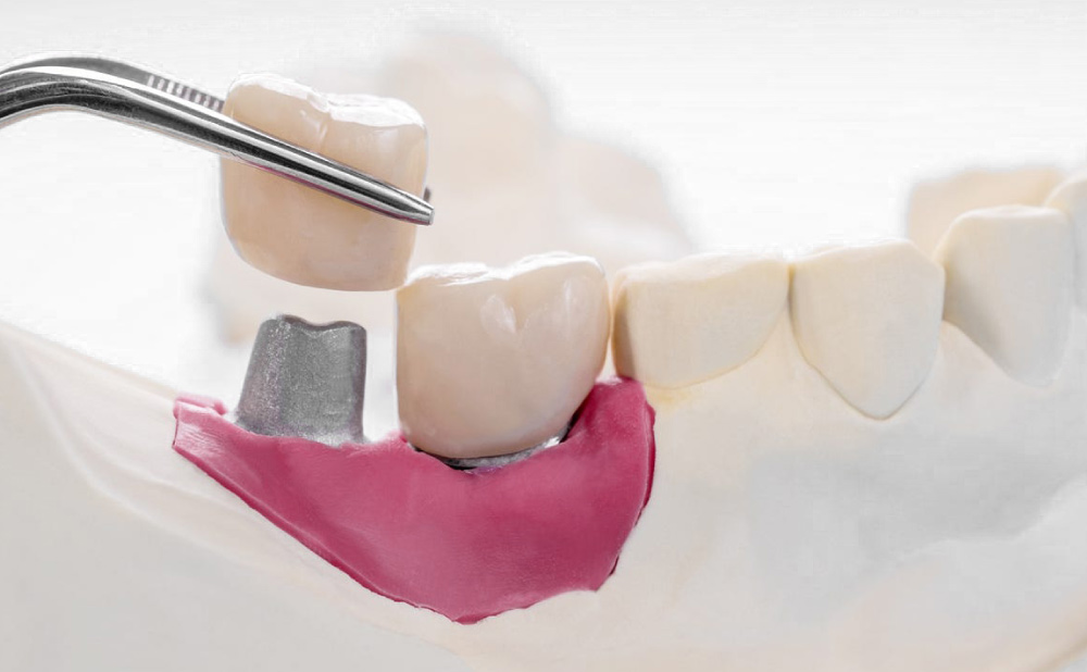 Zirconia Crowns in Turkey related image