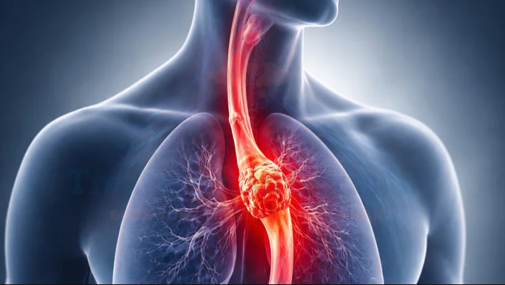 Esophageal Cancer Surgery related image