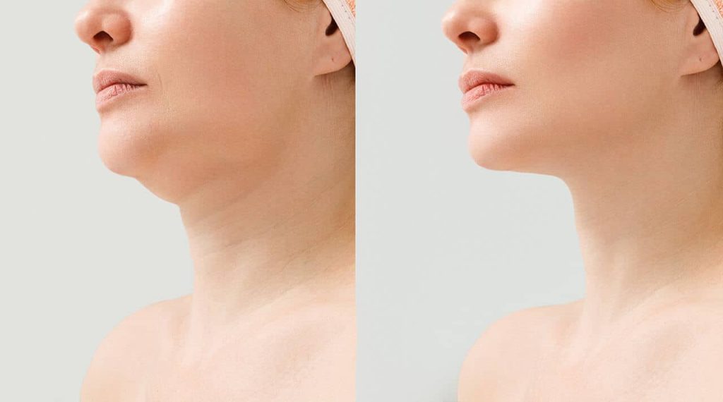 Chin Liposuction (Double Chin) in Turkey related image