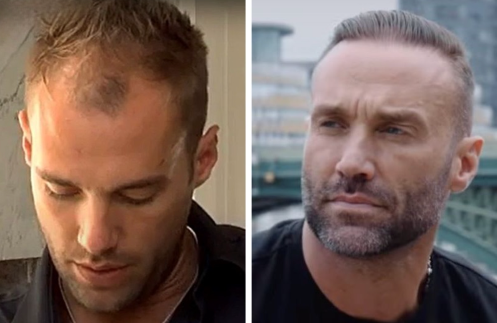 Celebrity Hair Transplants: Confirmed Cases, Costs, Photos related image