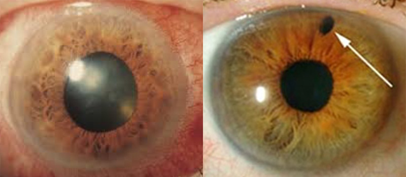 Glaucoma Surgery Abroad related image