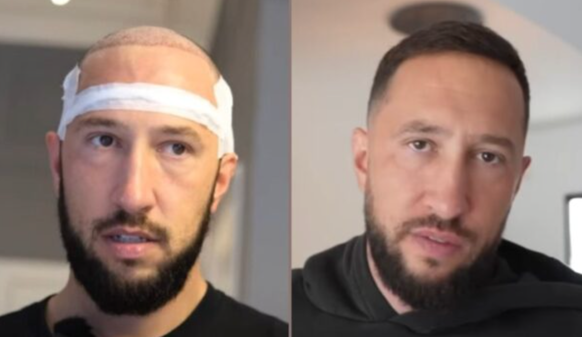Celebrity Hair Transplants: Confirmed Cases, Costs, Photos related image