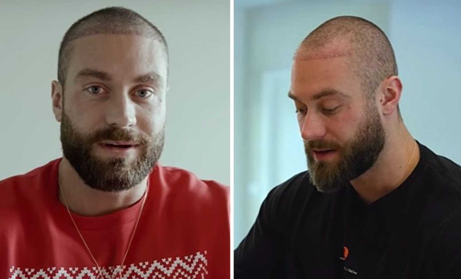Celebrity Hair Transplants: Confirmed Cases, Costs, Photos related image
