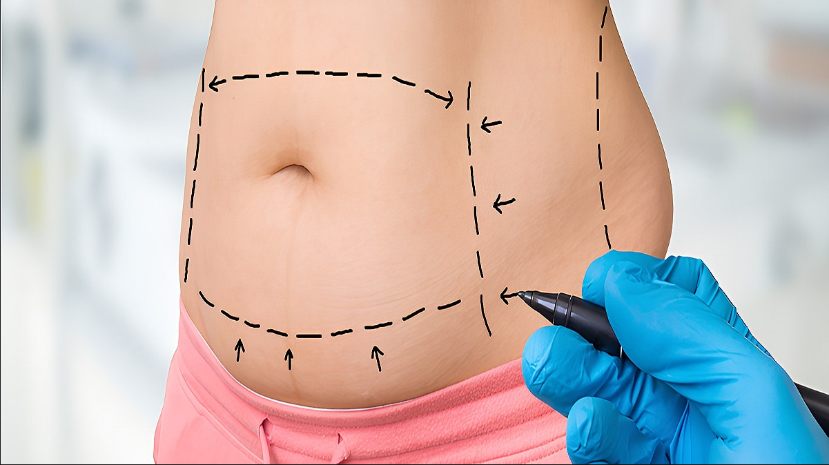 Mini Tummy Tuck in Turkey related image