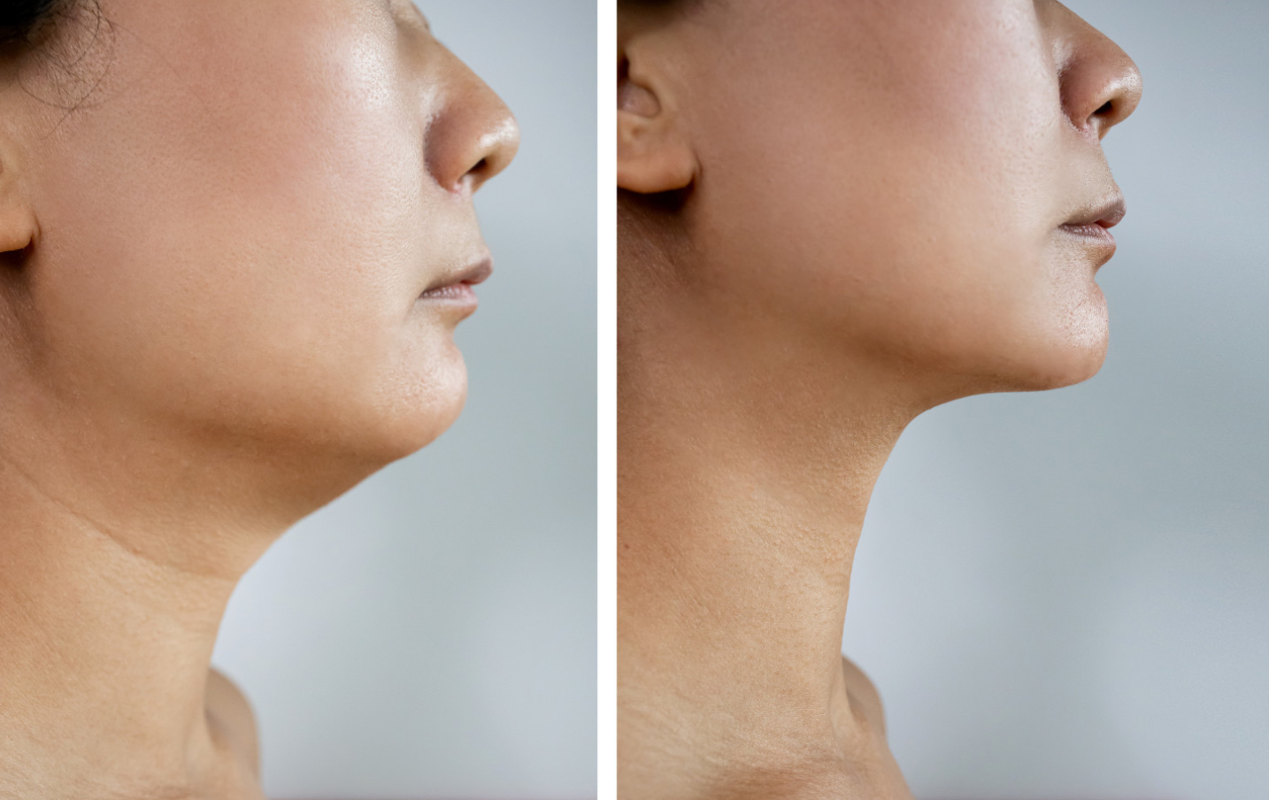 Chin Liposuction (Double Chin) in Turkey related image