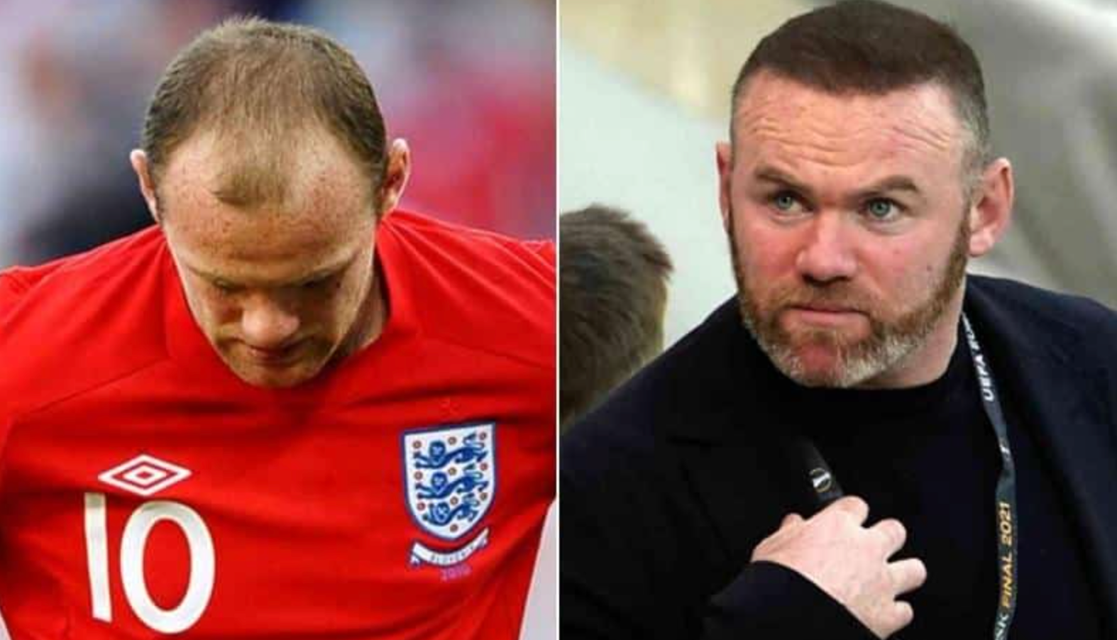 Celebrity Hair Transplants: Confirmed Cases, Costs, Photos related image