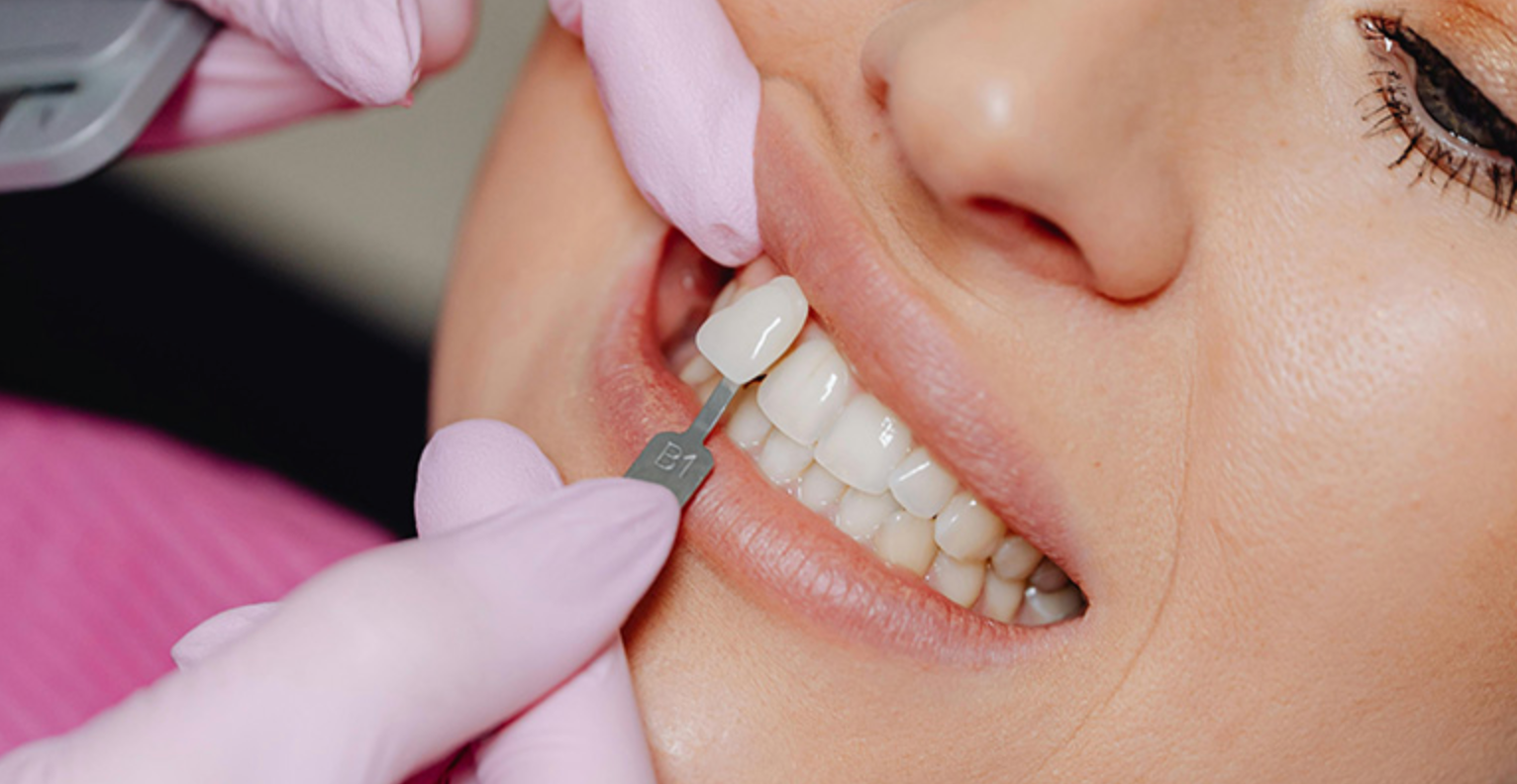 Emax Veneers in Turkey related image
