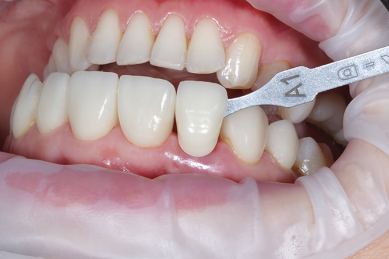 Emax Veneers in Turkey related image
