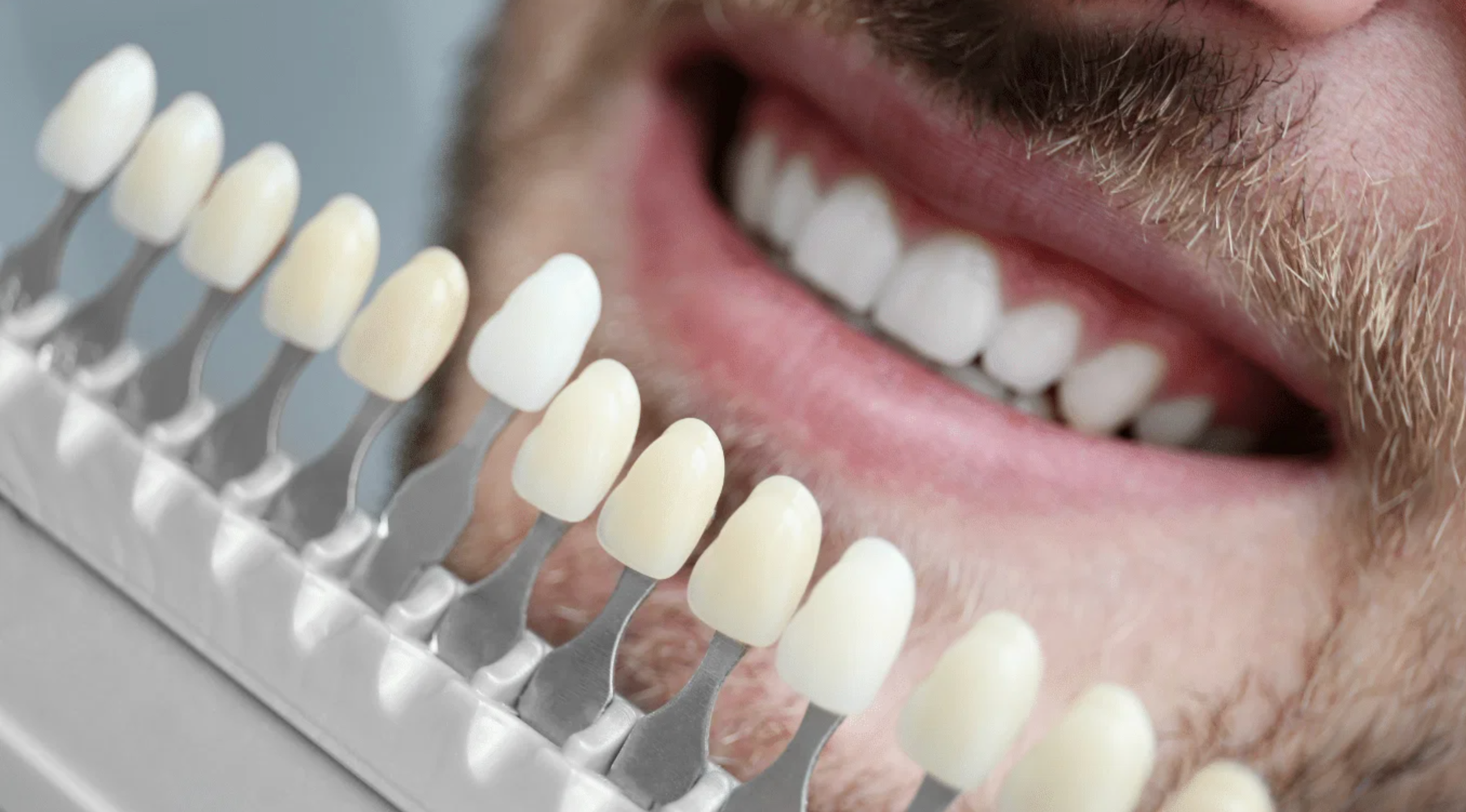 Emax Veneers in Turkey related image