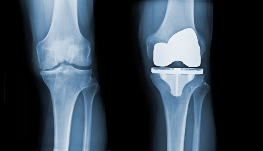 Total Knee Replacement in Spain related image