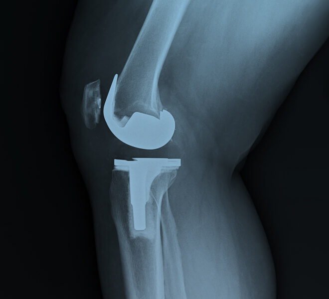 Total Knee Replacement in Spain related image