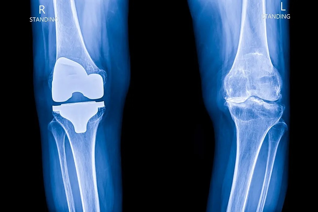 Total Knee Replacement in Spain related image
