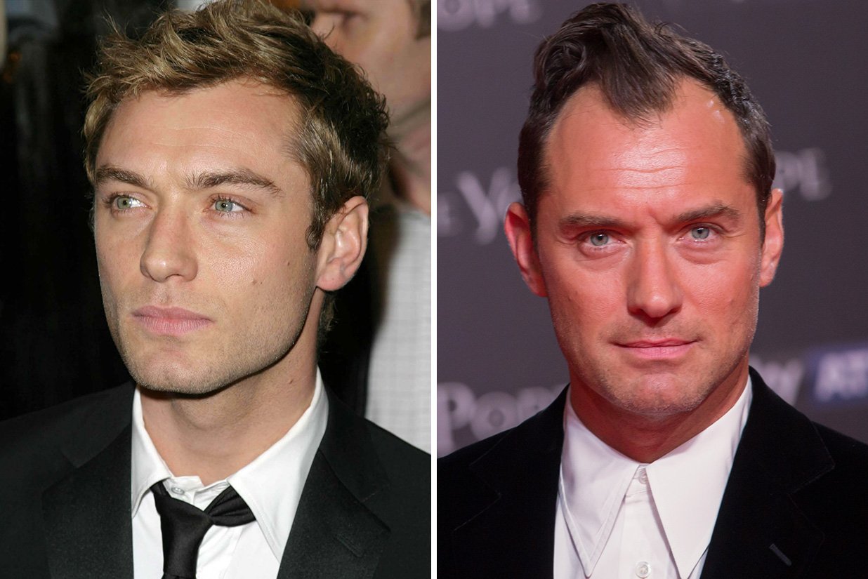 15 of the Famous Celebrity Hair Transplants | Before & After
