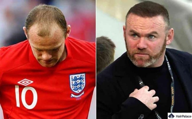 Wayne Rooney Hair Transplant Results