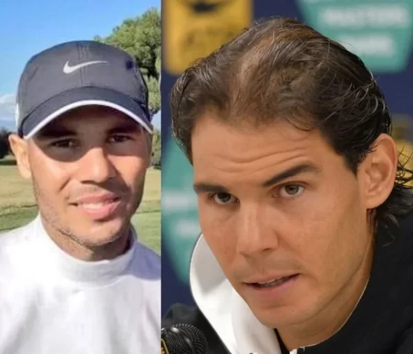 Rafael Nadal Hair Transplant Results